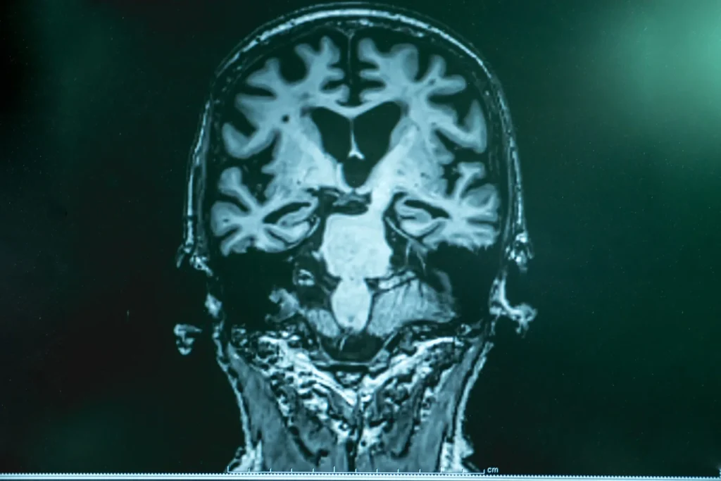 alzheimers-disease-mri