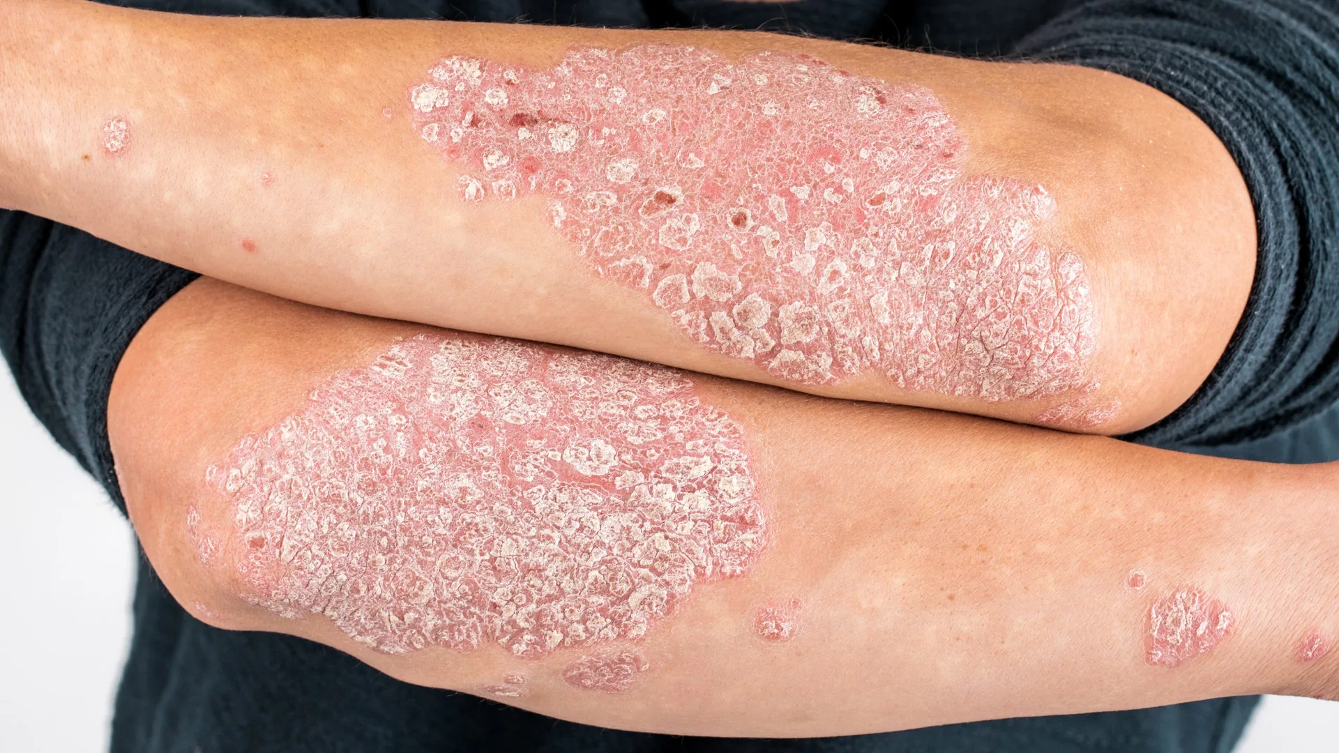man-sick-hands-dry-flaky-skin