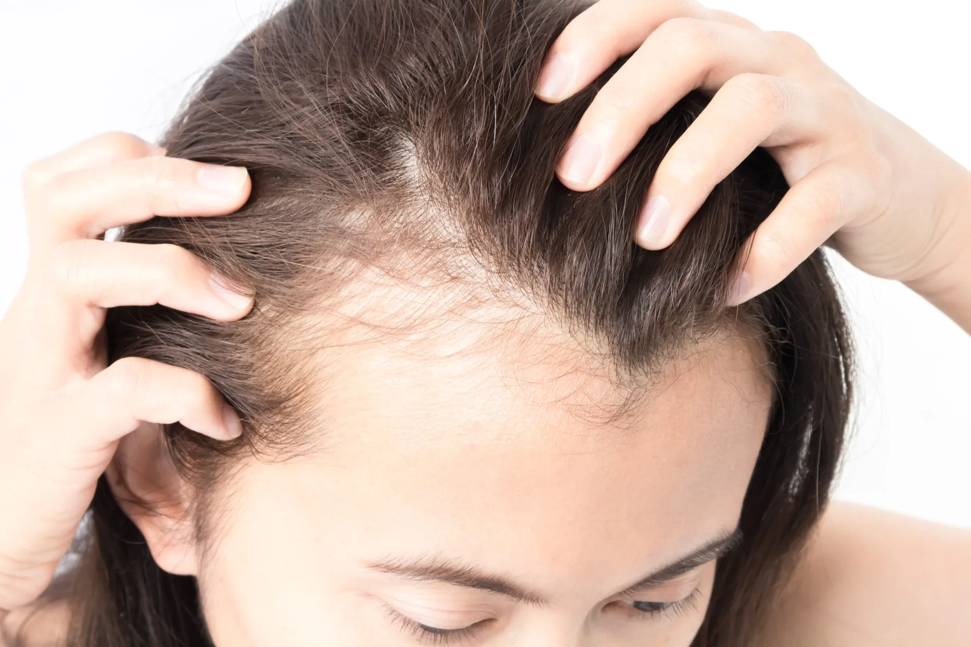 woman-serious-hair-loss-problem-health