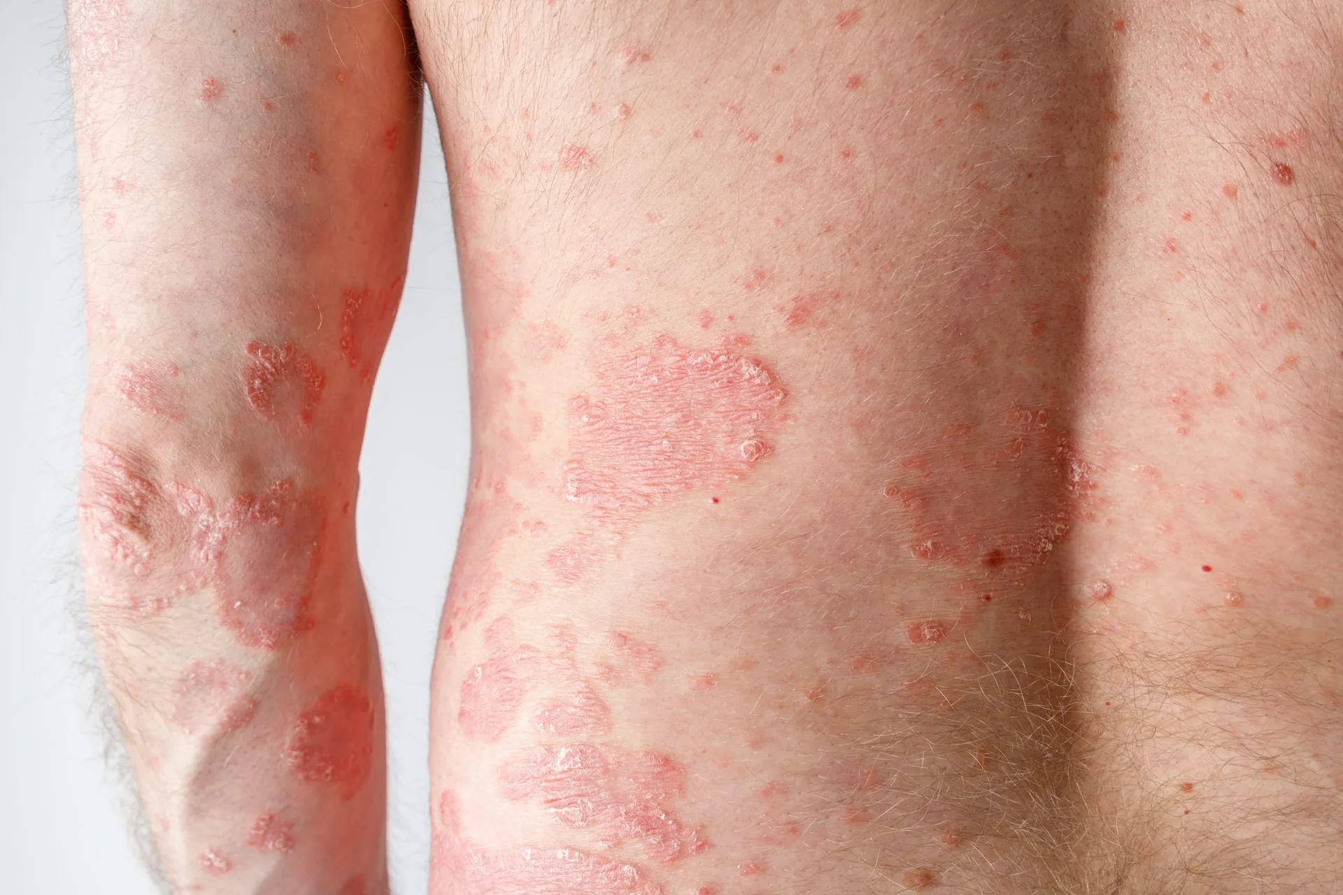 papules-chronic-psoriasis-vulgaris-on-male