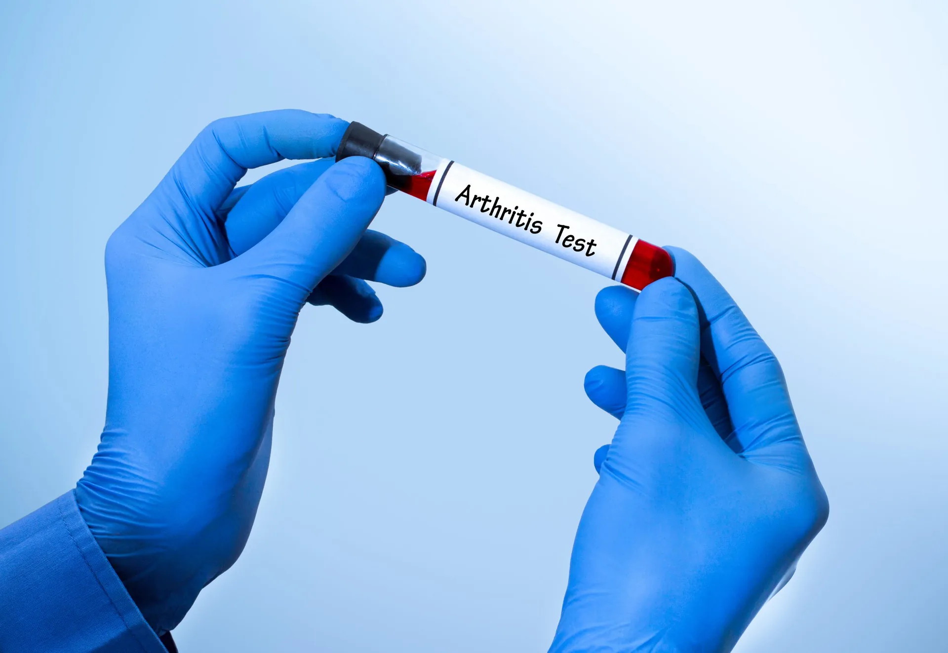 positive-result-blood-test-arthritis-tube